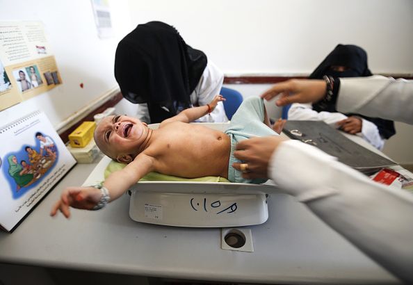 طفل يعاني من المجاعة في اليمن