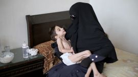 الطفلة السورية "رهف حوا" أثناء تلقيها العلاج مع والداتها 