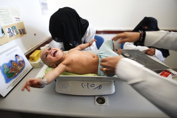 طفل يعاني من المجاعة في اليمن