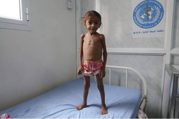 طفلة يمنية تعاني من المجاعة بعد حصار اليمن