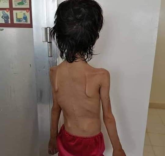 طفلة يمنية تعرضت للحبس والتعذيب على يد والدها