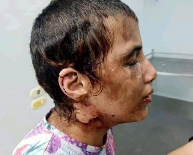تعرضت الطفلة أمنية لإصابات بالغة في جسدها جراء تعذيب وحشي طوال فترة خدمتها في بيت ضابط سابق بالأمن الوطني