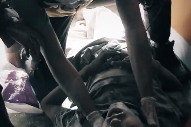 الطفل السوري المصاب في انفجار مدينة الباب السورية